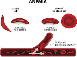 sickle cell disease: Swelling of hands & feet, fatigue, irritability:  Everything you need to know about sickle cell disease - The Economic Times